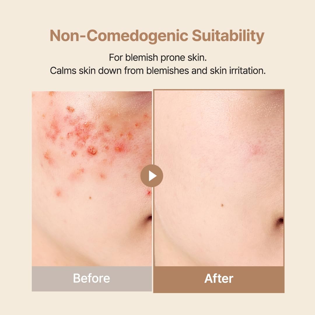 Before and after comparison of blemish-prone skin with a beige background.