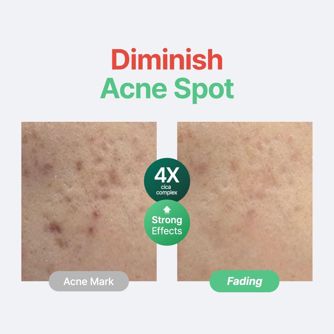 Before and after comparison of an acne spot treatment showing fading effects.