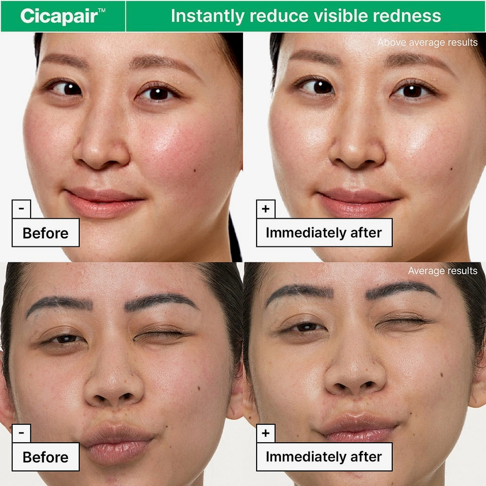 Before and after effects of Cicapair on visible redness with a person's face.