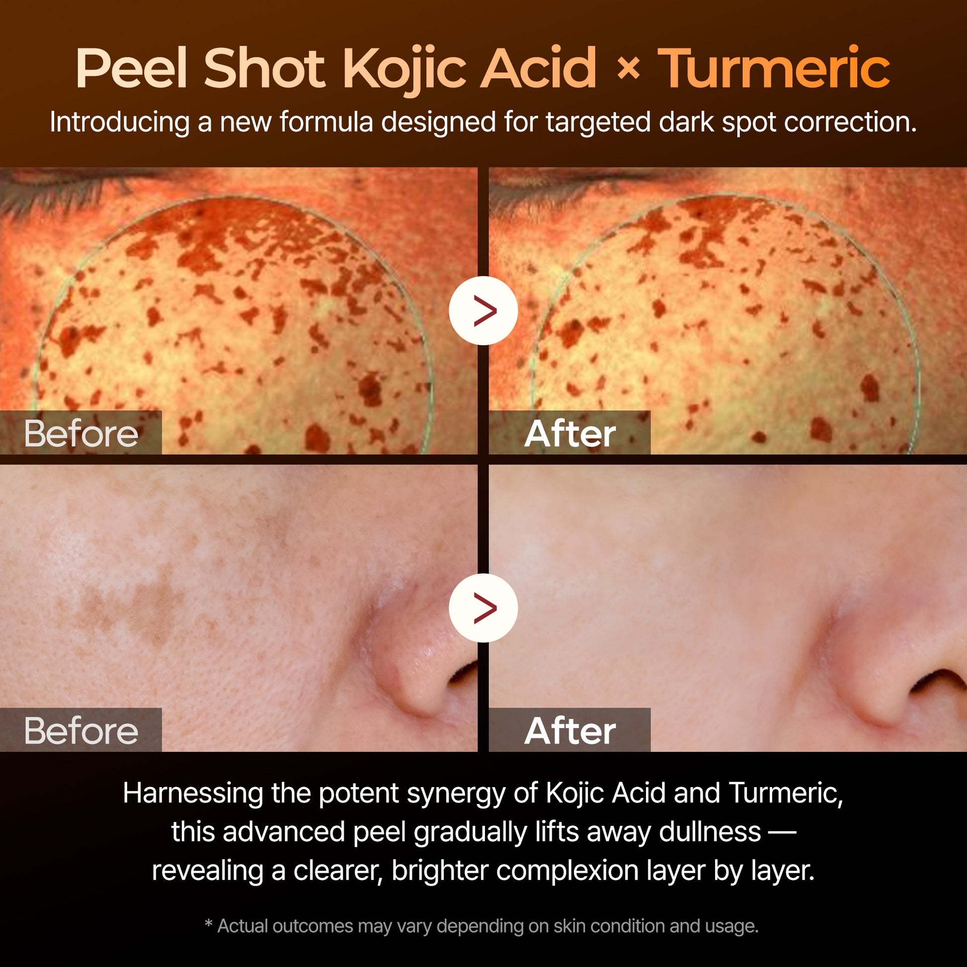 Before and after effects of a peel shot formula with Kojic Acid and Turmeric on skin.