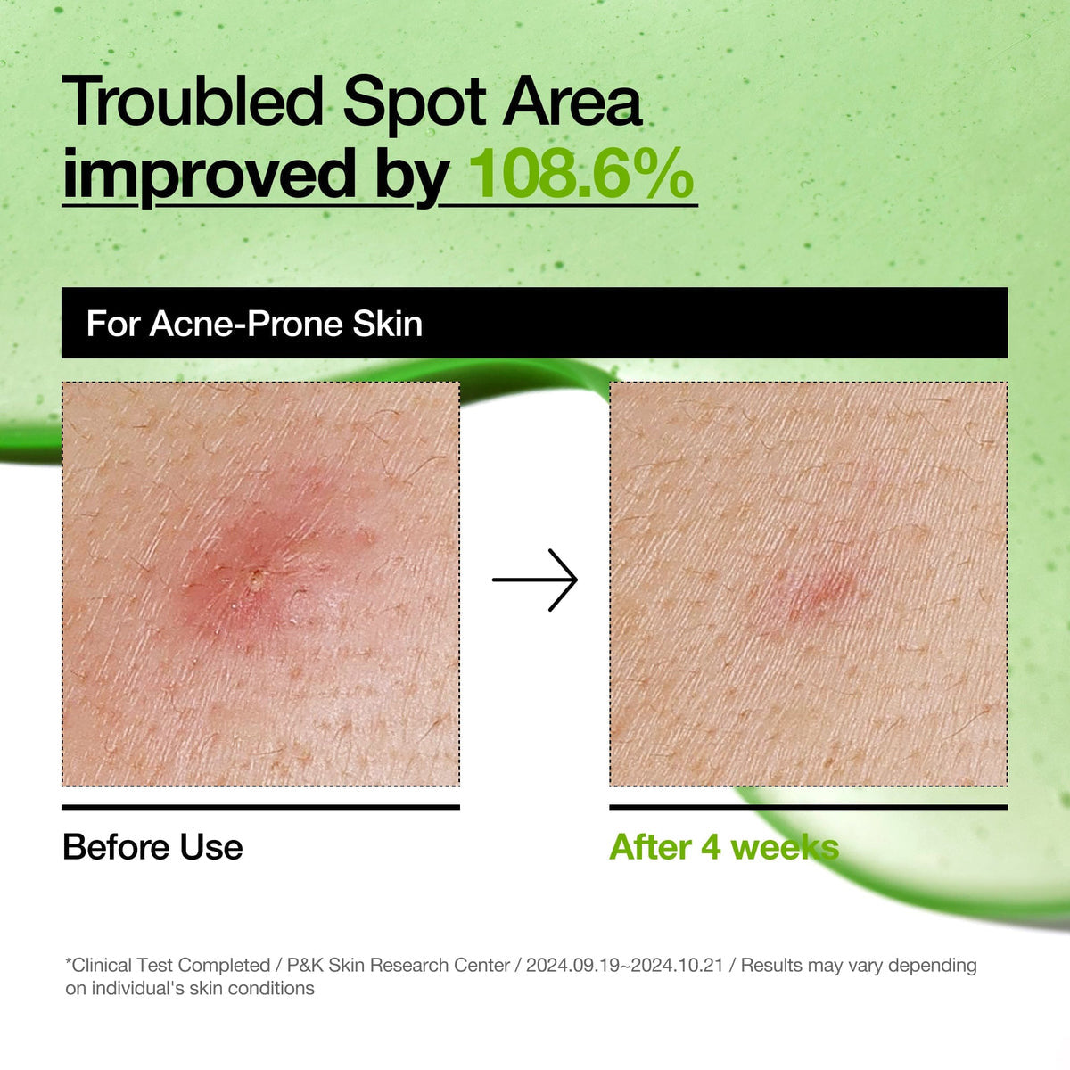 Anua Azelaic Acid 10% + Hyaluron Serum 30ml