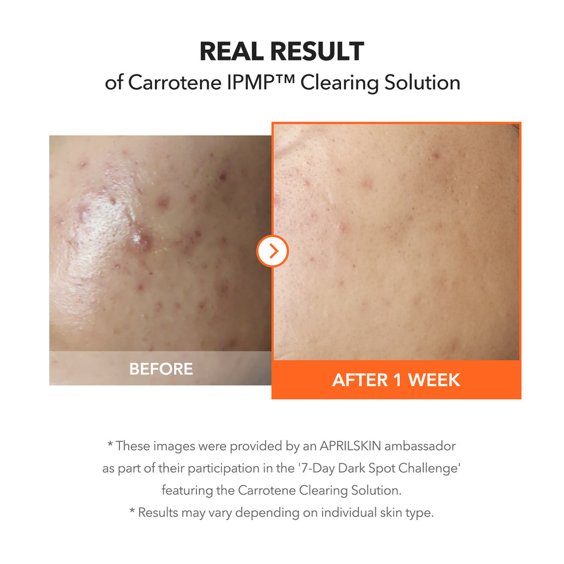 Before and after comparison of skin treatment with Carotene IPMP Clearing Solution, showing visible improvement.