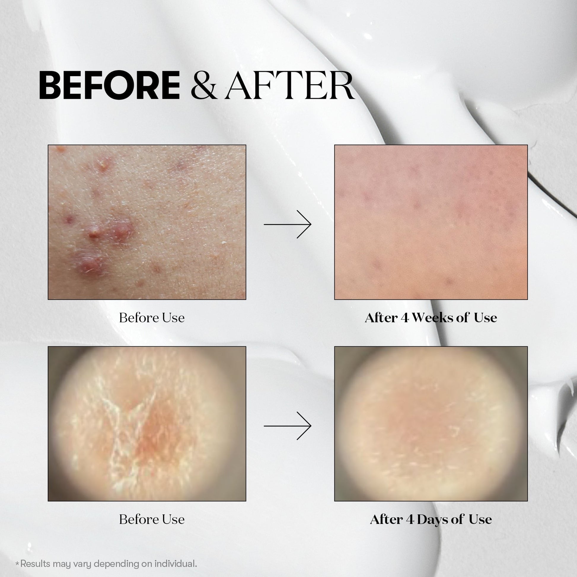 Before and after skin treatment results on a white background